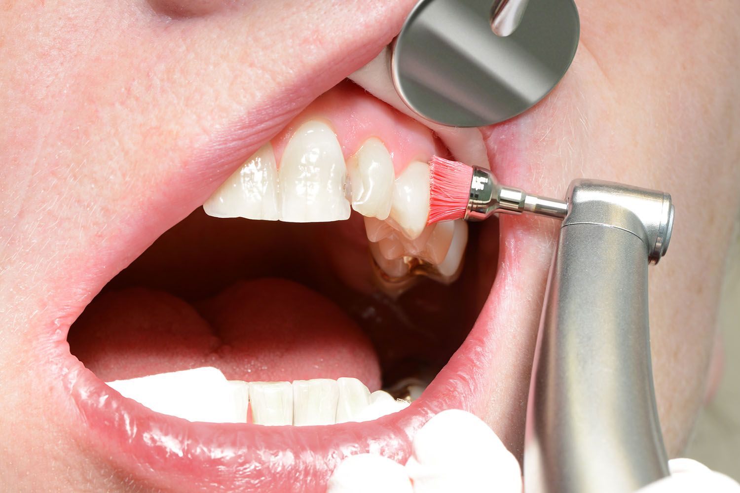 A rendszeres fogászati szűrés csökkentheti a szívbetegség és a stroke kockázatát